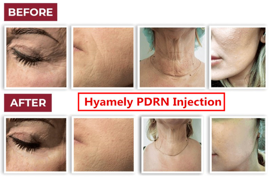 Soro do impulsionador PDRN da pele de Regation da pilha de Hyamely para o pescoço que clarea a injeção facial