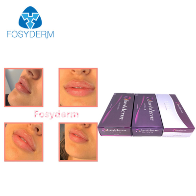 Lips Enhance Dermal Filler 2*1ml Juvederm Injeção de Ácido Hialurónico