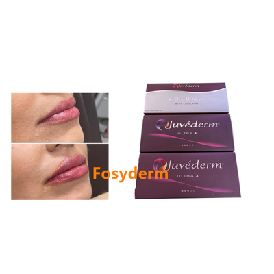 Juvederm 2*1ml Ácido hialurónico Preenchimento Dermológico Melhoria dos lábios Aumento do queixo