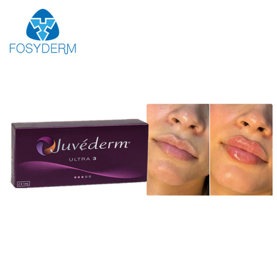 Juvederm 2*1ml Ácido hialurónico Preenchimento Dermológico Melhoria dos lábios Aumento do queixo