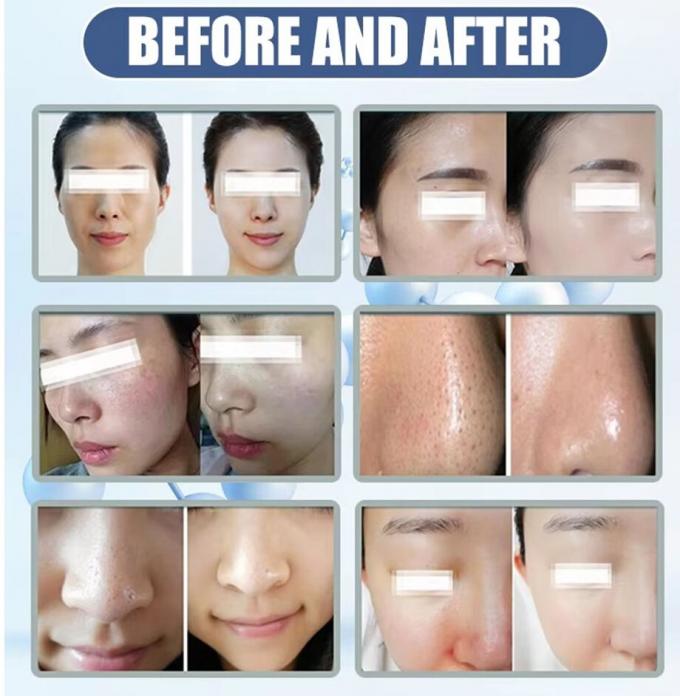 Melhor Cuidados Faciais em Casa Máquina de Microdermabrasia 2024 Equipamento de Beleza 6