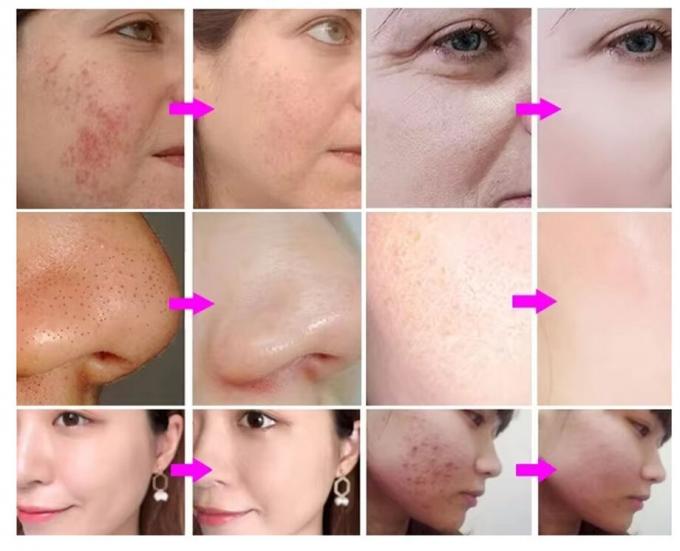 Hydra Peeling Facial Hydro Pequena água de bolha Hydro Aqua Facial H2o2 Hydra Machine 2
