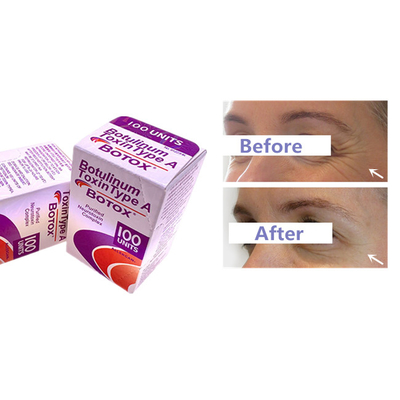 A injeção Botulinum de Allergan  da toxina para o enrugamento remove