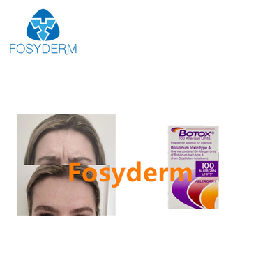 As injeções Botulinum da toxina de Allergan removem os enrugamentos 100 unidades