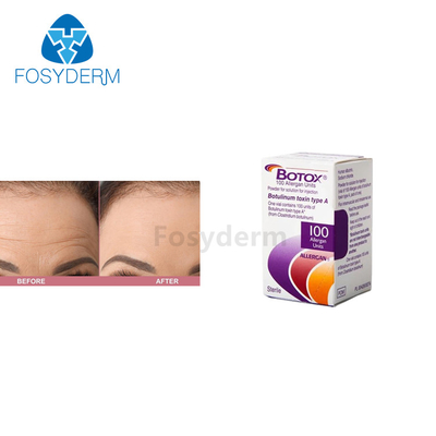 Injeção Botulinum da toxina de Allergan  de 100 unidades para anti enrugamentos