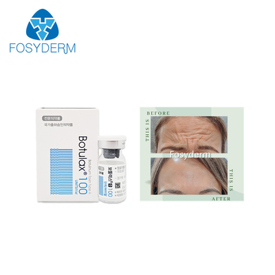 100 unidades datilografam a uma toxina Botulinum Allergan a anti injeção facial de  Botulax dos enrugamentos