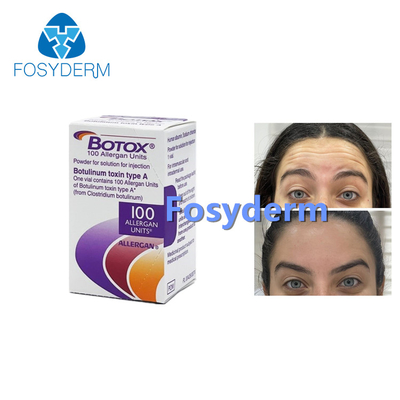 100 unidades de Toxina Botulínica Alergênica Anti-Rugas Injecção Botox Tipo A