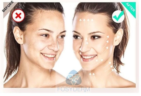 Filorga  135ha 5*3ml Mesoterapia facial por injecção para melhorar a qualidade da pele