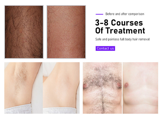 Máquina de remoção de pelos a laser de diodo 3 ondas 16 barras de remoção de cabelo corpo facial