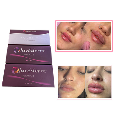 Injecções de cuidados com a pele Plumper de lábios Juvederm Ácido hialurónico Preenchimento dérmico para o rosto