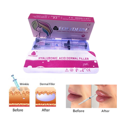 Fosyderm 2 ml Gel de Ácido Hialurónico Injecções de Enchimento dérmico para cuidados da pele do rosto e do nariz