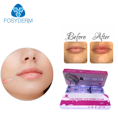 Enchimento facial subcutâneo com ácido hialurónico