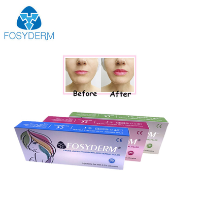 Gel de 1 ml de enchimento de ácido hialurónico para redução de rugas e moldagem facial