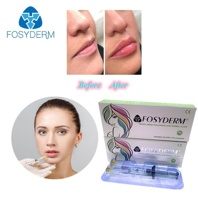 Gel de 1 ml de enchimento de ácido hialurónico para redução de rugas e moldagem facial