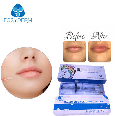OEM Hyaluronic Acid Dermal Filler para pele grossa e radiante