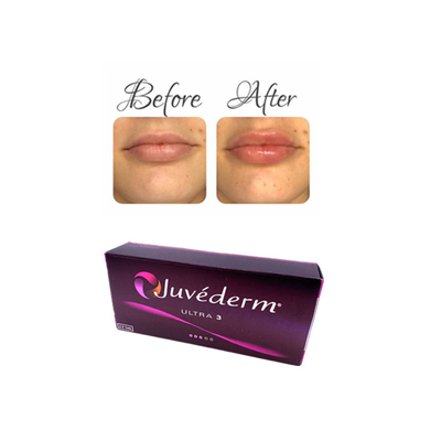 Juvederm Ácido Hialurónico Injetável Gel de Enchimento Dermológico