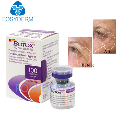 100 Unidades Botulinum Toxina Antirrugas Alergânica Injecção  Para Tratamento Antienvelhecimento