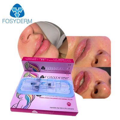 Preenchimento Dérmico HA para Rejuvenescimento Facial para Rosto, Queixo, Bochechas, Lábios, Corpo, Bumbum
