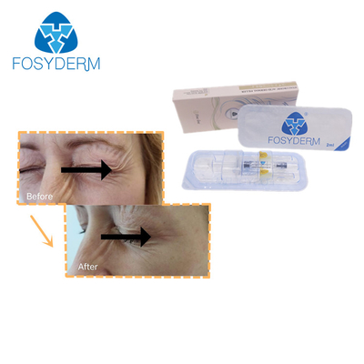 A cruz de Fosyderm ligou o ácido hialurónico da linha tênue do enchimento 2ml do HA para enrugamentos do olho