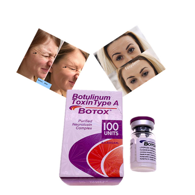 Tipo Botulinum da toxina de Allergan um ácido hialurónico do enchimento cutâneo da unidade de  100