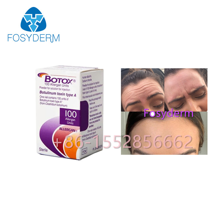 Allergan  100 enrugamentos da toxina Botulinum das unidades anti datilografa uma injeção