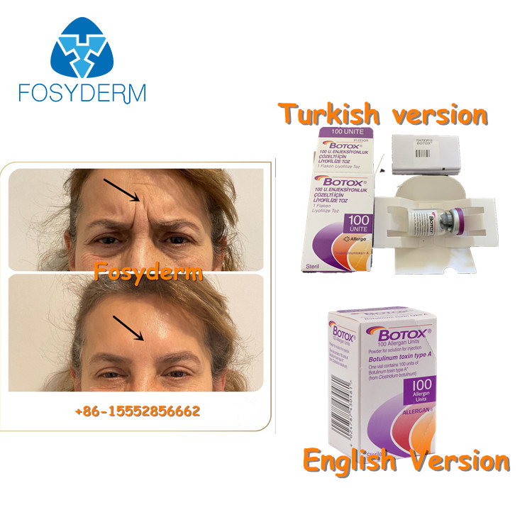 100Units Allergan Toxion Botulinum para removem o tipo facial A de  dos enrugamentos