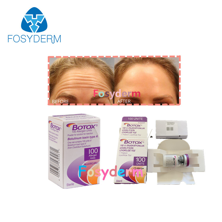 anti injeção Botulinum TypeA  de Allergan da toxina do enrugamento 100Units