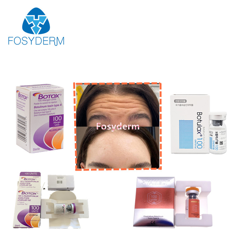 da injeção Botulinum da toxina de 100units TypeA anti enrugamentos  Allergan