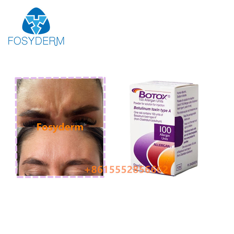 Remover rugas Injecção Allergan Toxina Botulínica  Tipo A 100 unidades