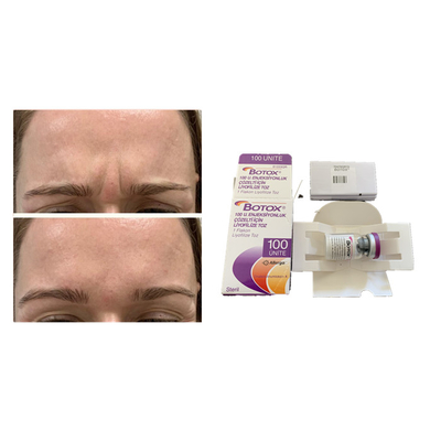 Injeção antienvelhecimento de  da toxina Botulinum branca de Allergan