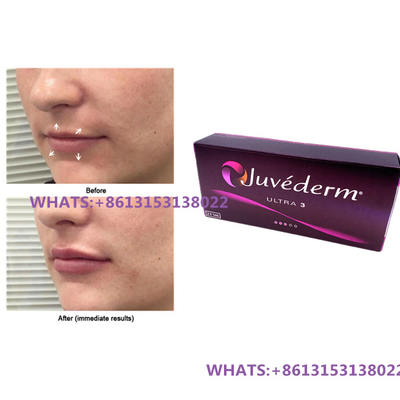 Juvederm Preenchimento Dermico Para Lábios Juvederm Ultra3 Ultra4 Preenchimentos Seringa pré- cheia