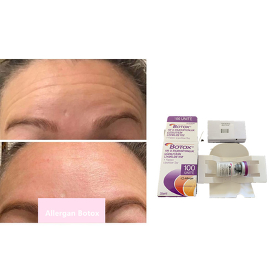 Injeção Botulinum do pó da toxina da remoção 100units Allergan  do enrugamento