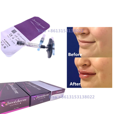 2×1 ml de Enchimento Cérmico Injetável Juvederm Seringa Ultra3 Ultra4 Voluma