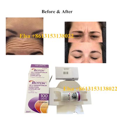 Tipo Botulinum da toxina de Allergan da injeção um 100units antienvelhecimento