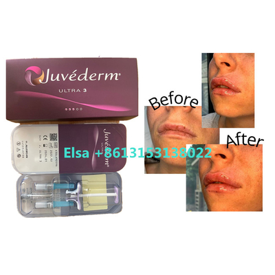 Enchimento cutâneo de Juvederm dos produtos cosméticos para os bordos da cara