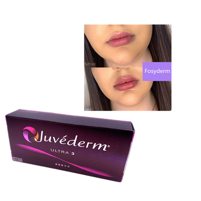 2 ml Juvederm Ácido Hialurónico Preenchimento Dermológico Preenchimento de Rugas Chin Lips Ultra 3