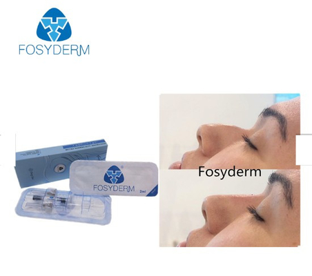 A cruz de Fosyderm ligou a linha profunda enchimento cutâneo do enchimento 2ml para o nariz acima