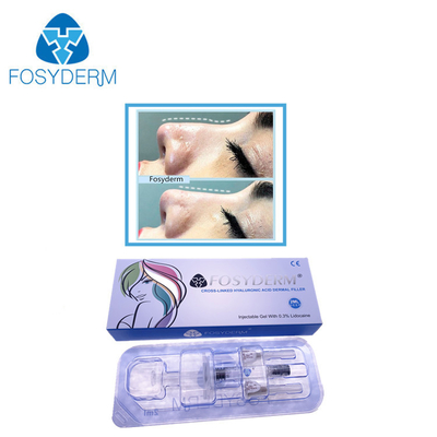 Linha profunda nariz cutâneo ácido hialurónico de 2 Ml do enchimento acima com Lidocaine
