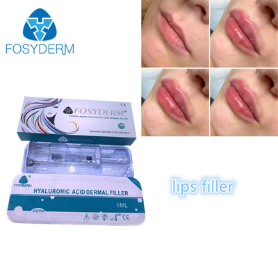 Enchimentos ácidos hialurónicos de enchimento 1ml do bordo de Fosyderm Fosyderm da injeção da cara